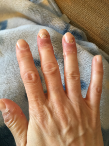 自家感作性皮膚炎写真　脱ステ悪化後期の手