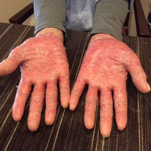 尋常性乾癬の手のひらの激しい皮剥け、リバウンド