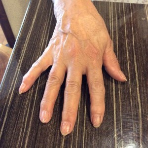 掌蹠膿疱症手の爪改善後