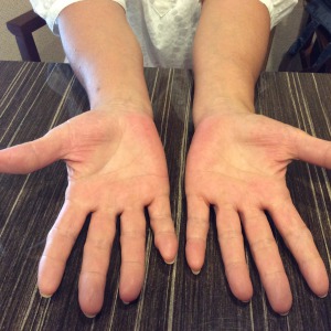 掌蹠膿疱症手のひら改善後