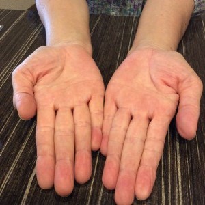 掌蹠膿疱症の改善　再発無し